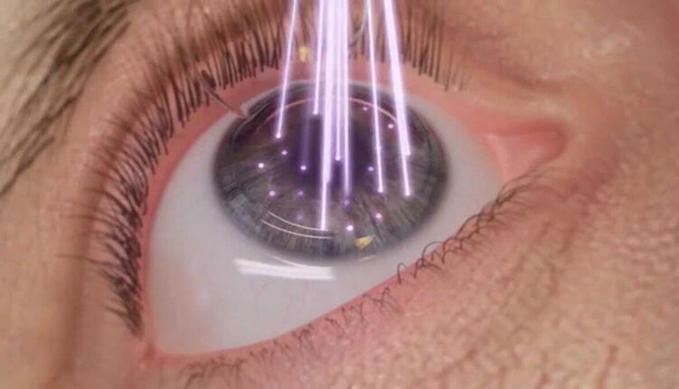 chirurgie des yeux au laser