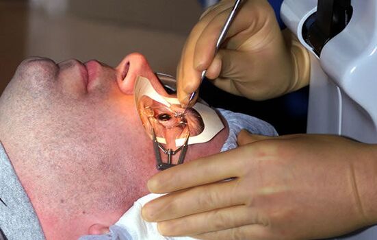 Scléroplastie pour myopie pour stabiliser la vision.