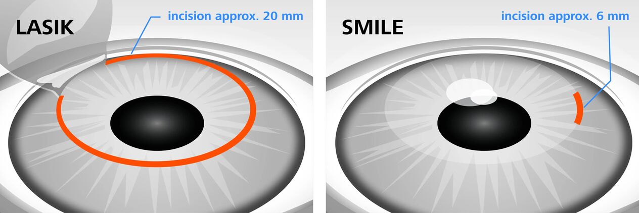 Comparaison des méthodes de correction de la vue au laser LASIK et SMILE